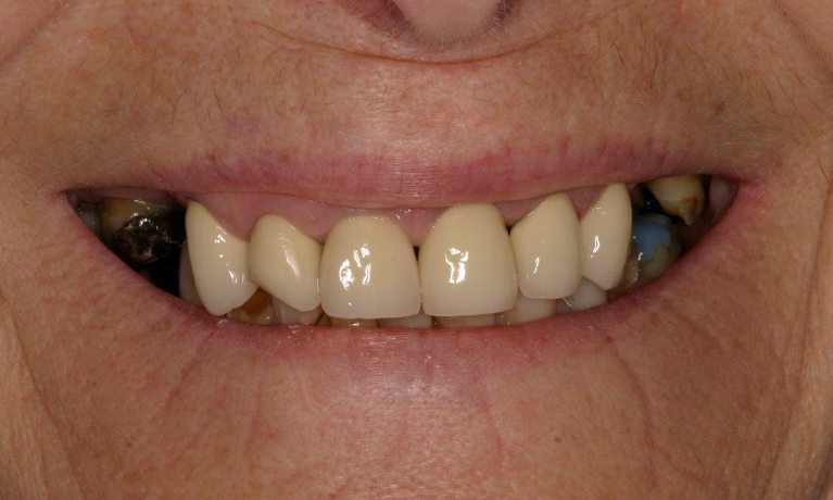Crowns-Bridges-near-Mount-Pleasant-Before-Image