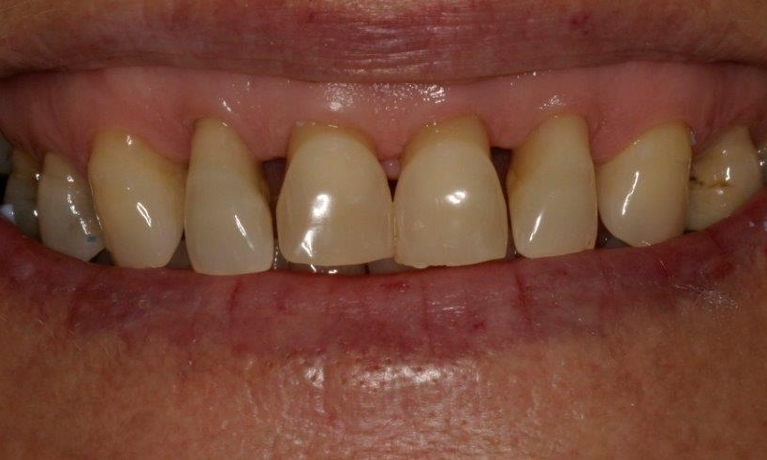 Full-Ceramic-Crowns-Near-Alfred-Cove-Before-Image