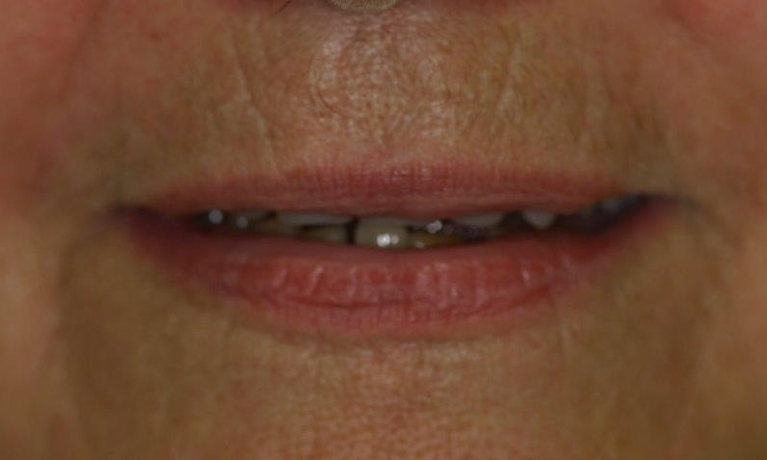 Full-Dentures-in-Booragoon-WA-Before-Image