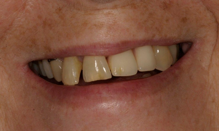 Full-Mouth-Reconstructions-with-Implants-in-Booragoon-WA-Before-Image