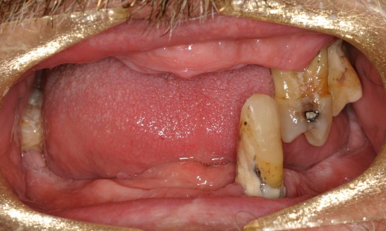Full-Mouth-Reconstructions-with-Implants-Before-Image