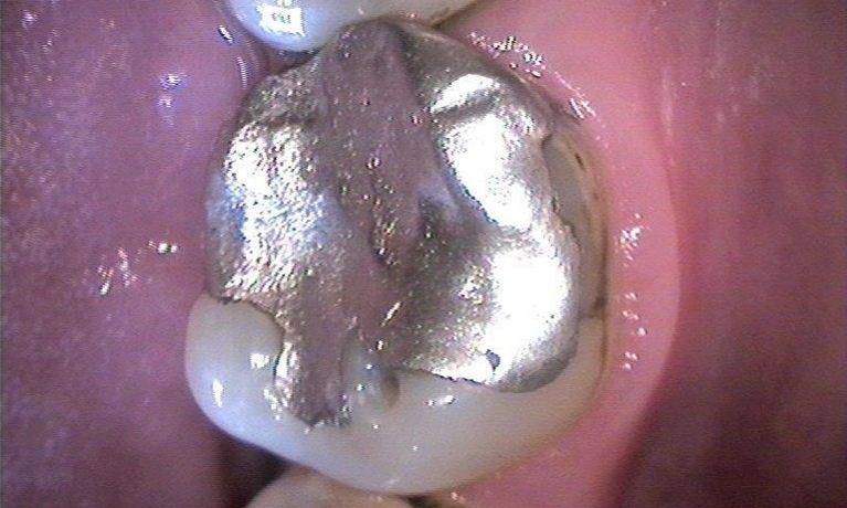 Porcelain-Fillings-Restoration-Before-Image